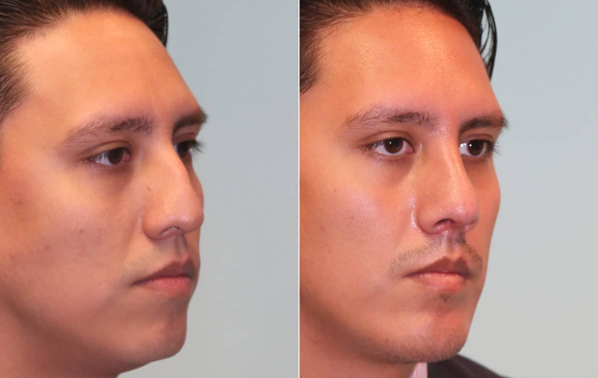 Before and after Rhinoplasty by Dr. Shervin Naderi, Patient 15714