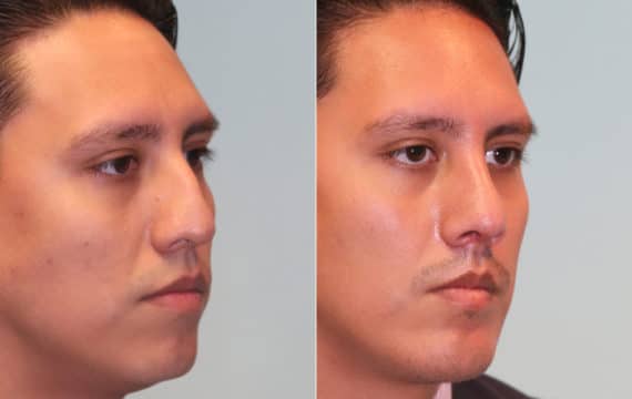 Before and after Rhinoplasty by Dr. Shervin Naderi, Patient 15714