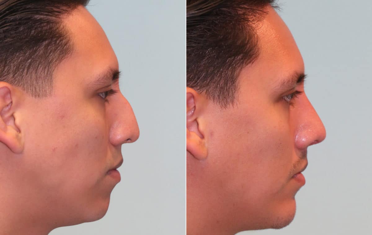 Before and after Rhinoplasty by Dr. Shervin Naderi, Patient 15714