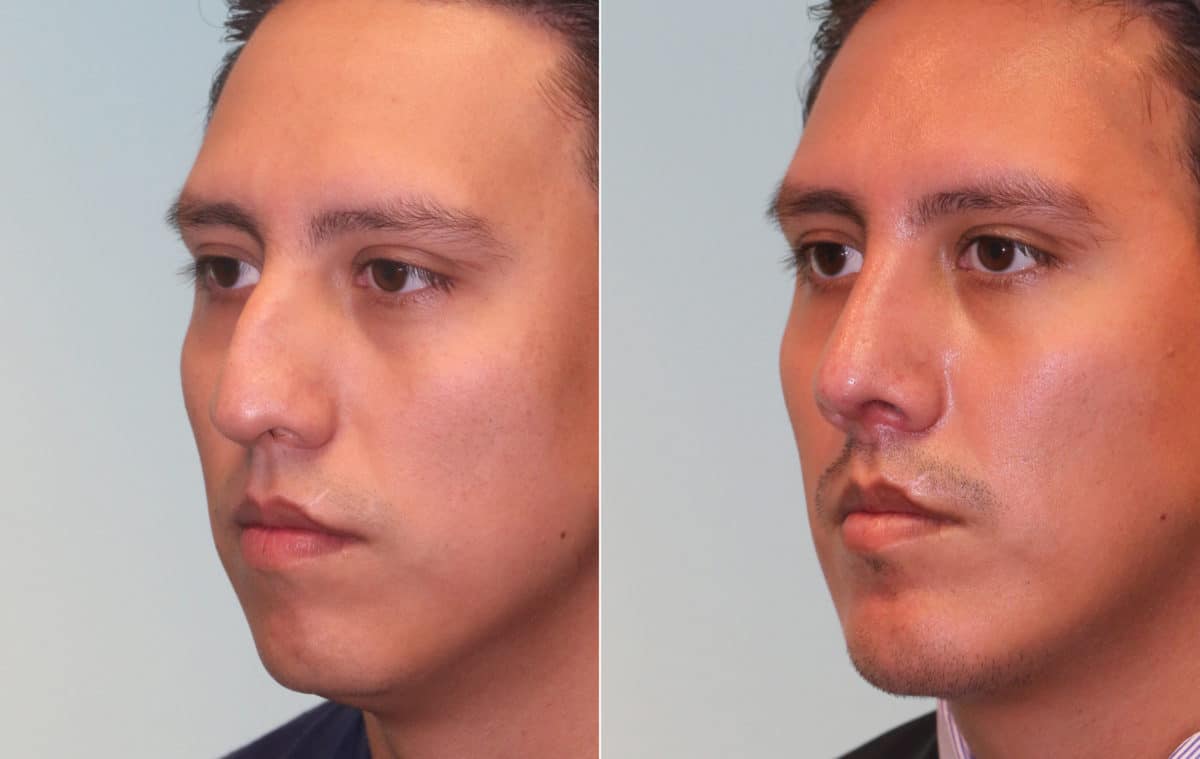 Before and after Rhinoplasty by Dr. Shervin Naderi, Patient 15714