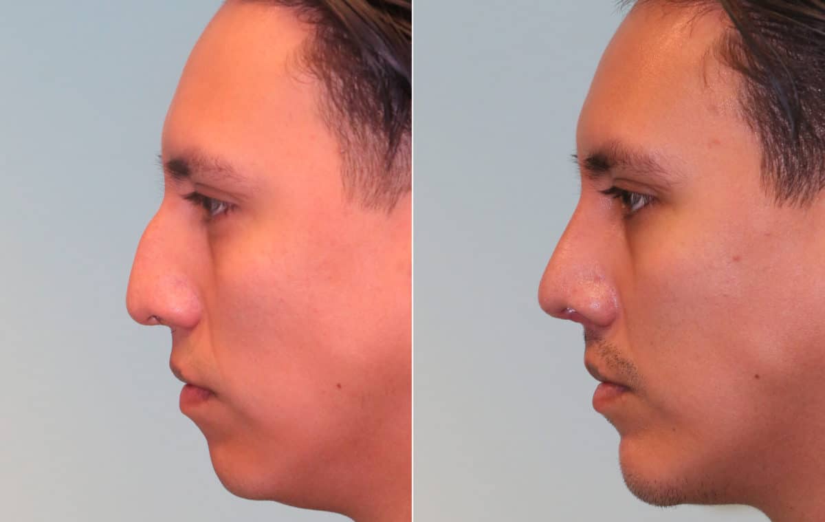 Before and after Rhinoplasty by Dr. Shervin Naderi, Patient 15714