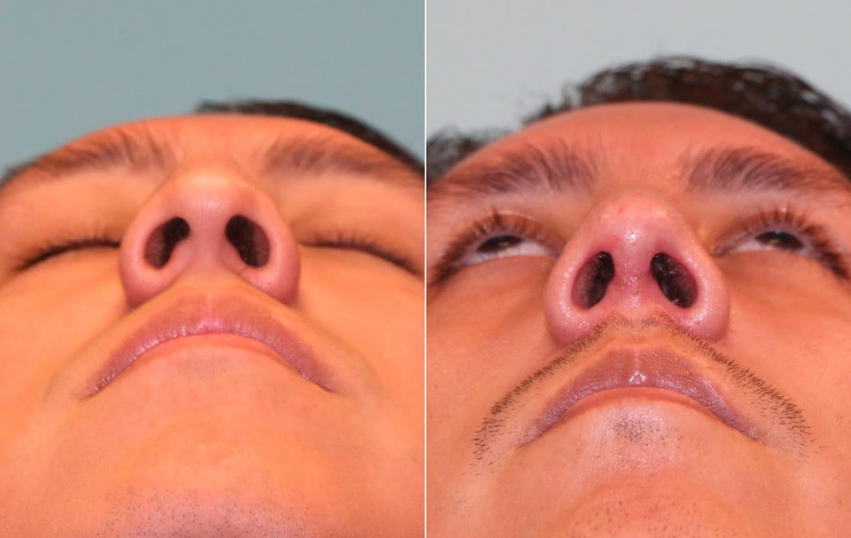 Before and after Rhinoplasty by Dr. Shervin Naderi, Patient 15714