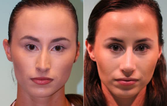 Before and after Rhinoplasty by Dr. Shervin Naderi, Patient 15657