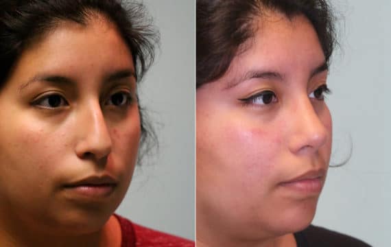 Before and after Rhinoplasty by Dr. Shervin Naderi, Patient 15674