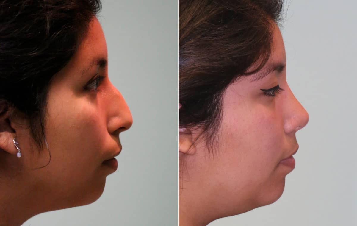 Before and after Rhinoplasty by Dr. Shervin Naderi, Patient 15674