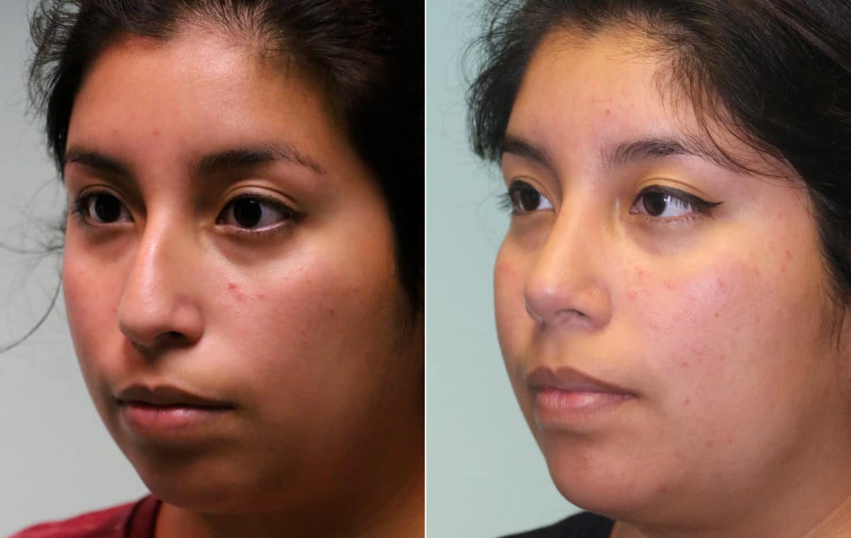 Before and after Rhinoplasty by Dr. Shervin Naderi, Patient 15674