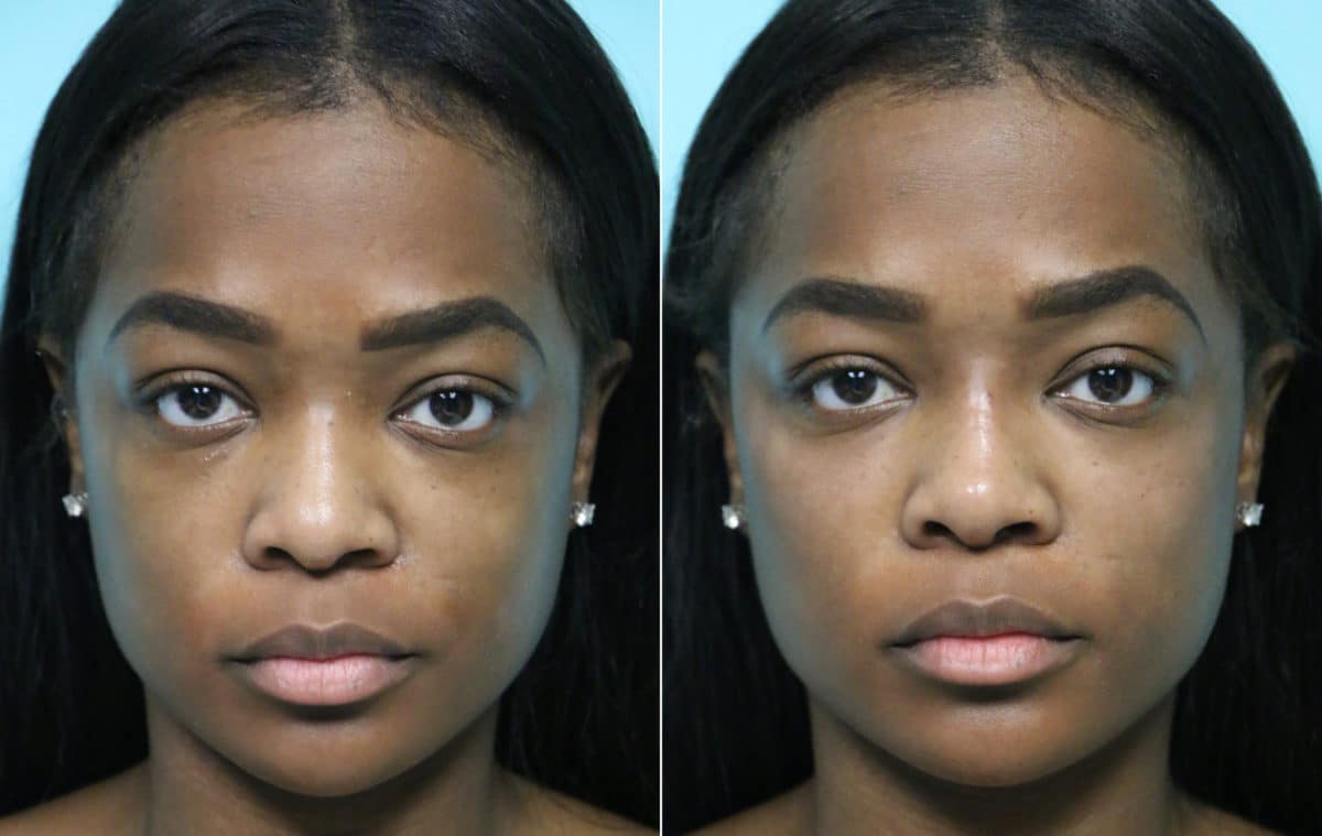 Before and after Non-Surgical Rhinoplasty by Dr. Shervin Naderi, Patient 15755