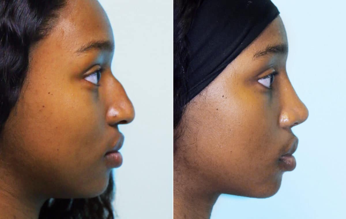 Before and after Rhinoplasty by Dr. Shervin Naderi, Patient 15952