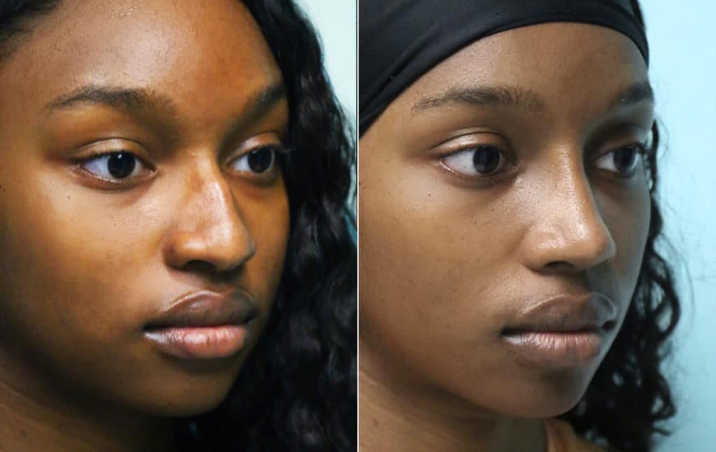 Rhinoplasty before and after photos Page 5 of 21 The Naderi Center