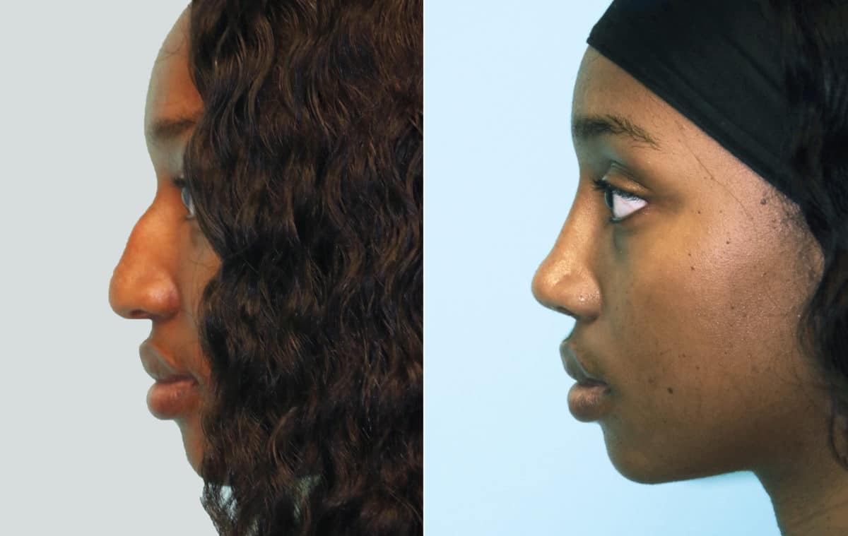 Before and after Rhinoplasty by Dr. Shervin Naderi, Patient 15952