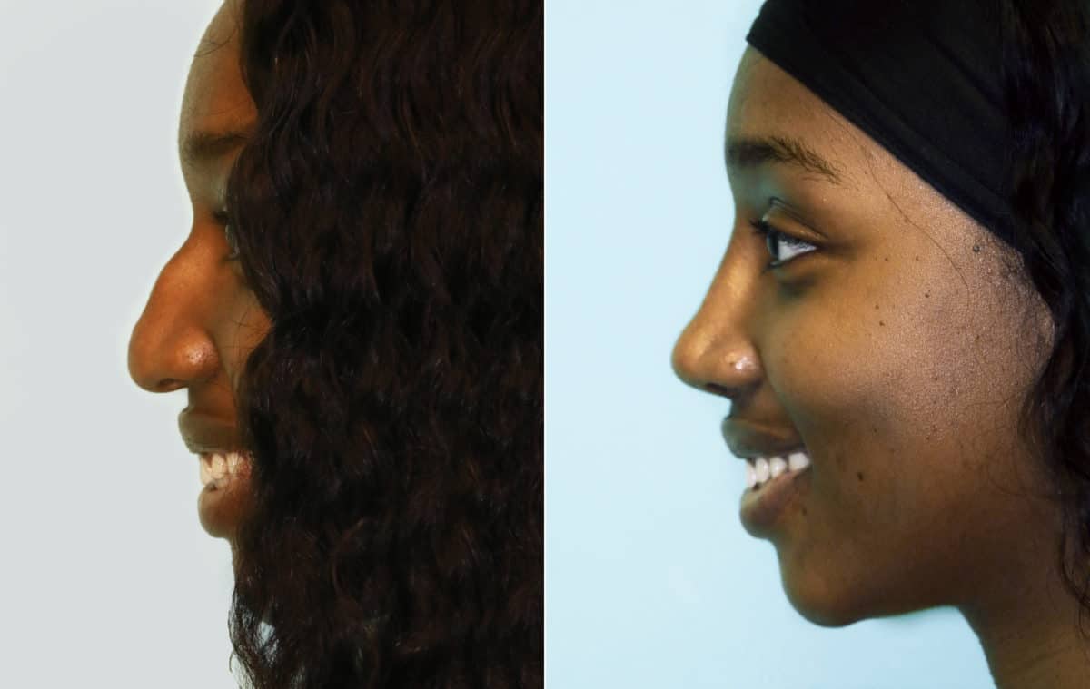 Before and after Rhinoplasty by Dr. Shervin Naderi, Patient 15952