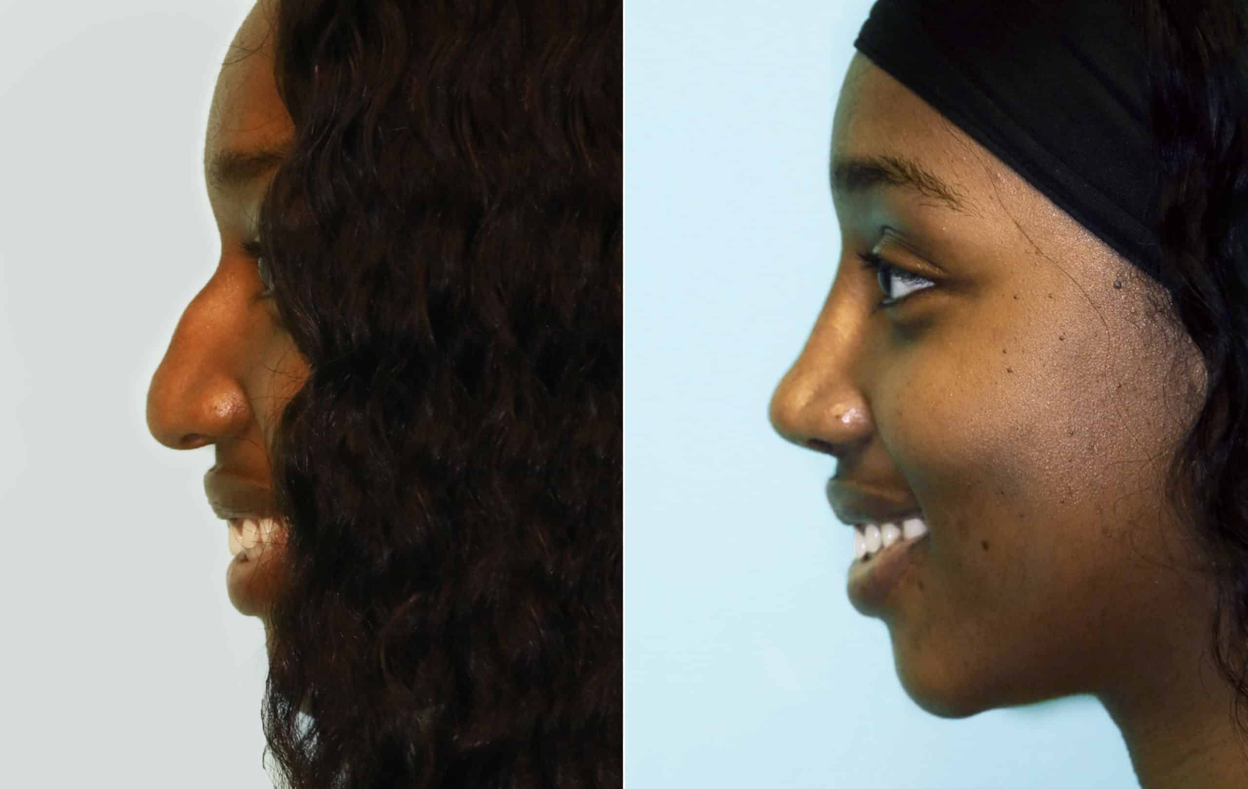 patient-15952-rhinoplasty-before-after
