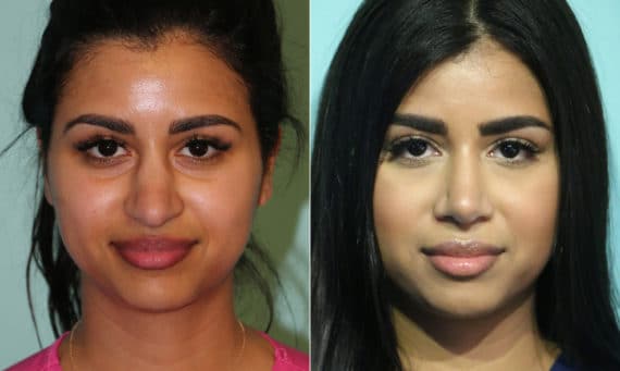 Before and after Rhinoplasty by Dr. Shervin Naderi, Patient 15990