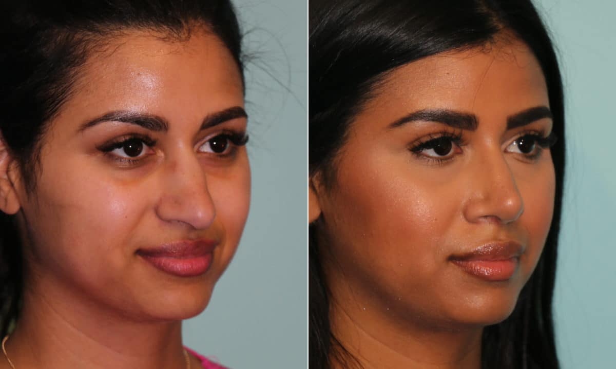 Before and after Rhinoplasty by Dr. Shervin Naderi, Patient 15990