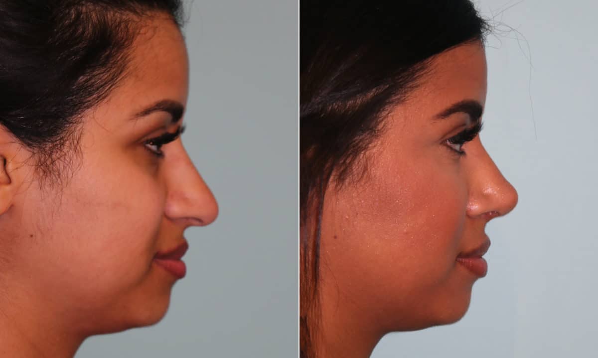 Before and after Rhinoplasty by Dr. Shervin Naderi, Patient 15990