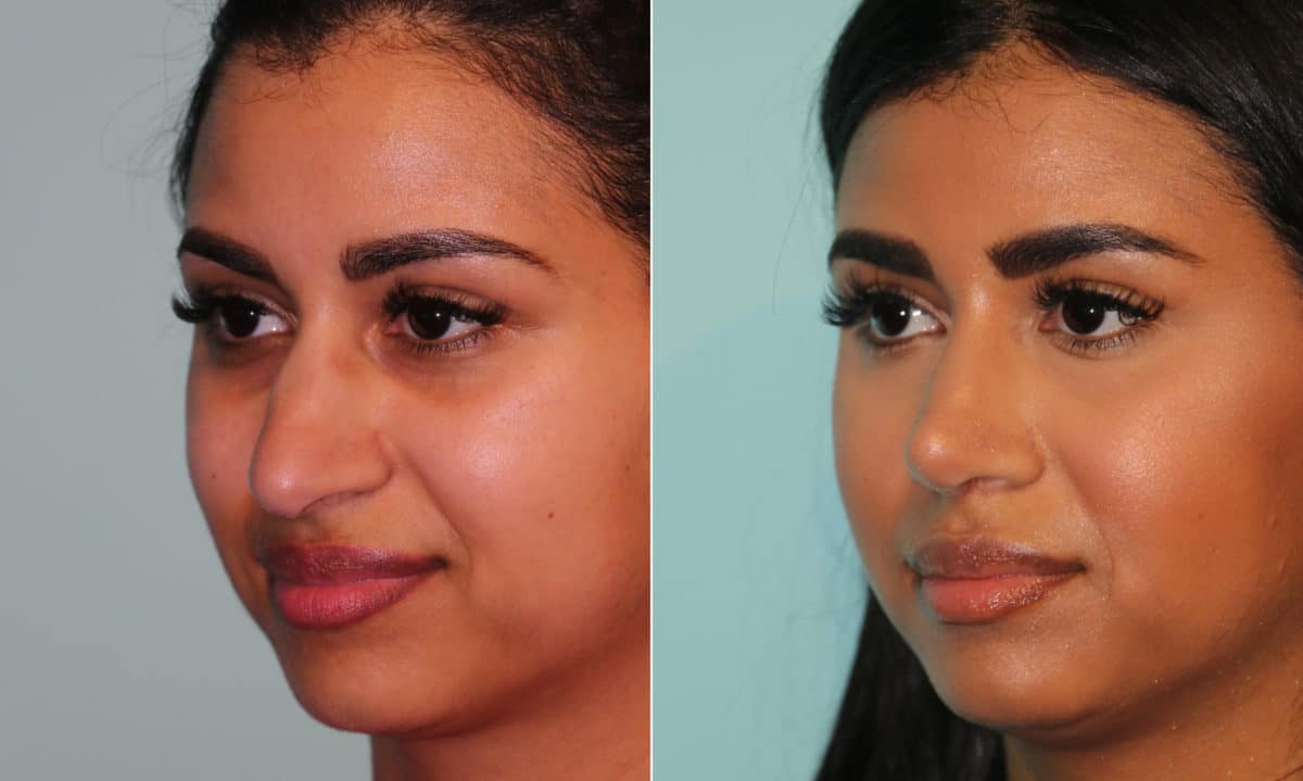 Before and after Rhinoplasty by Dr. Shervin Naderi, Patient 15990