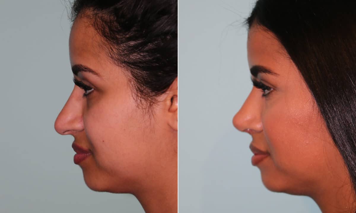 Before and after Rhinoplasty by Dr. Shervin Naderi, Patient 15990