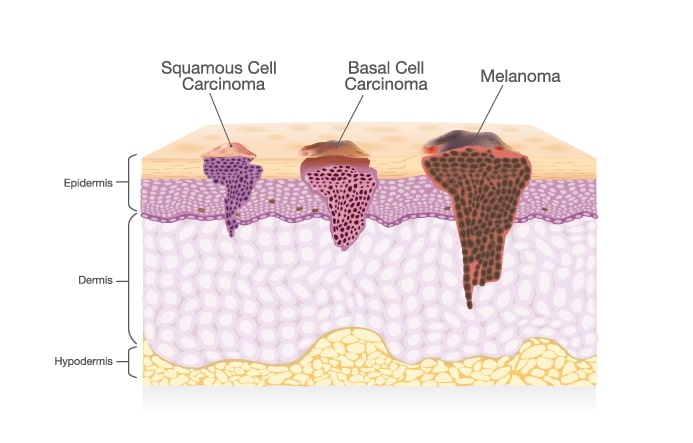 Types of skin cancer | The Naderi Center in Virginia