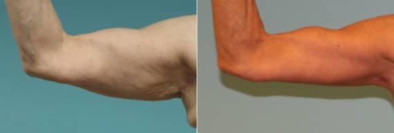 Before and after Brachioplasty (Arm Lift) by Dr. Shervin Naderi, Patient 16099