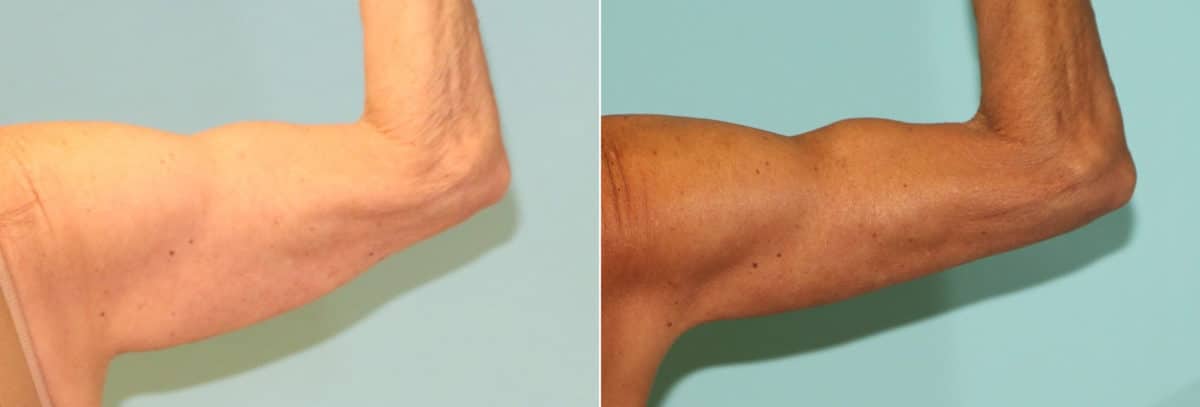 Before and after Brachioplasty (Arm Lift) by Dr. Shervin Naderi, Patient 16099