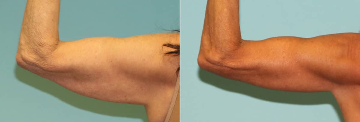 Before and after Brachioplasty (Arm Lift) by Dr. Shervin Naderi, Patient 16099
