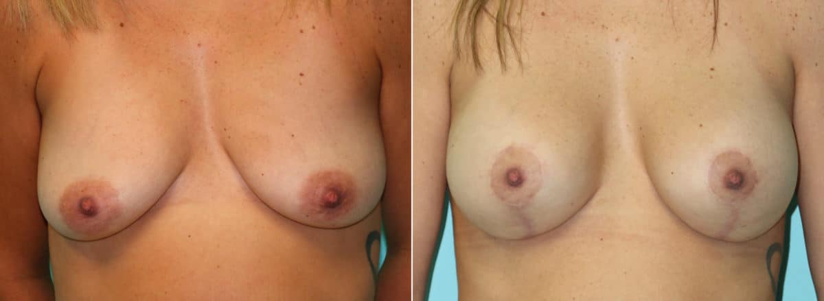 Before and after Breast Lift by Dr. Shervin Naderi, Patient 16129