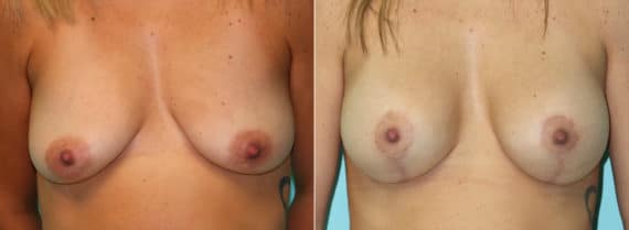 Before and after Breast Lift by Dr. Shervin Naderi, Patient 16129