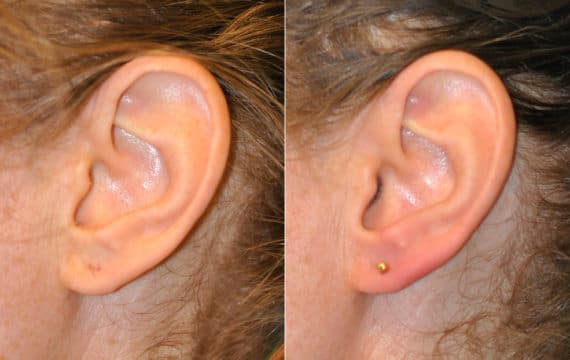 Before and after Ear Lobe Repair by Dr. Shervin Naderi, Patient 16113