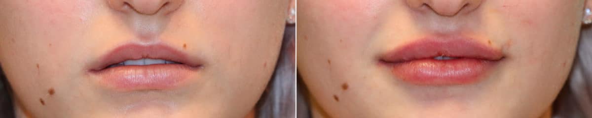 Before and after Lip Augmentation by Dr. Shervin Naderi, Patient 16114