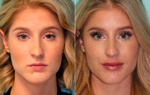 Before and after Lip Augmentation by Dr. Shervin Naderi, Patient 16116