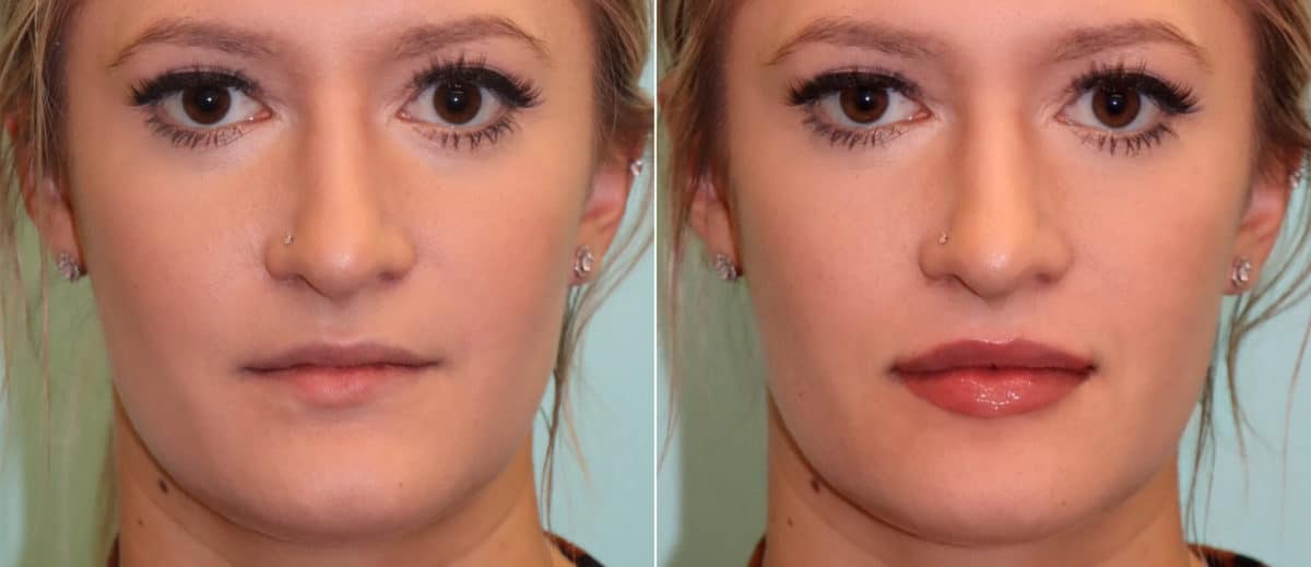 Lip Augmentation Photos Chevy Chase Md Patient 16139