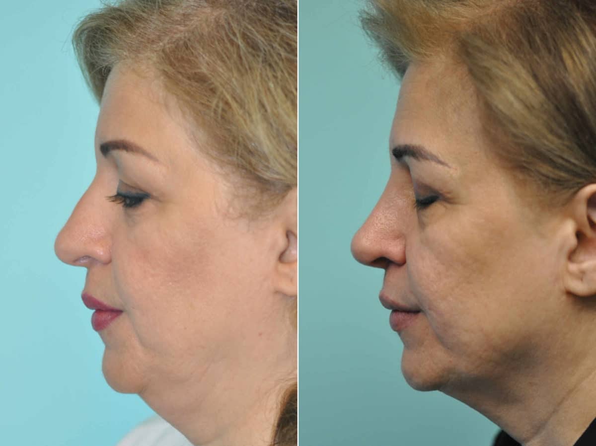 Before and after Rhinoplasty by Dr. Shervin Naderi, Patient 12939