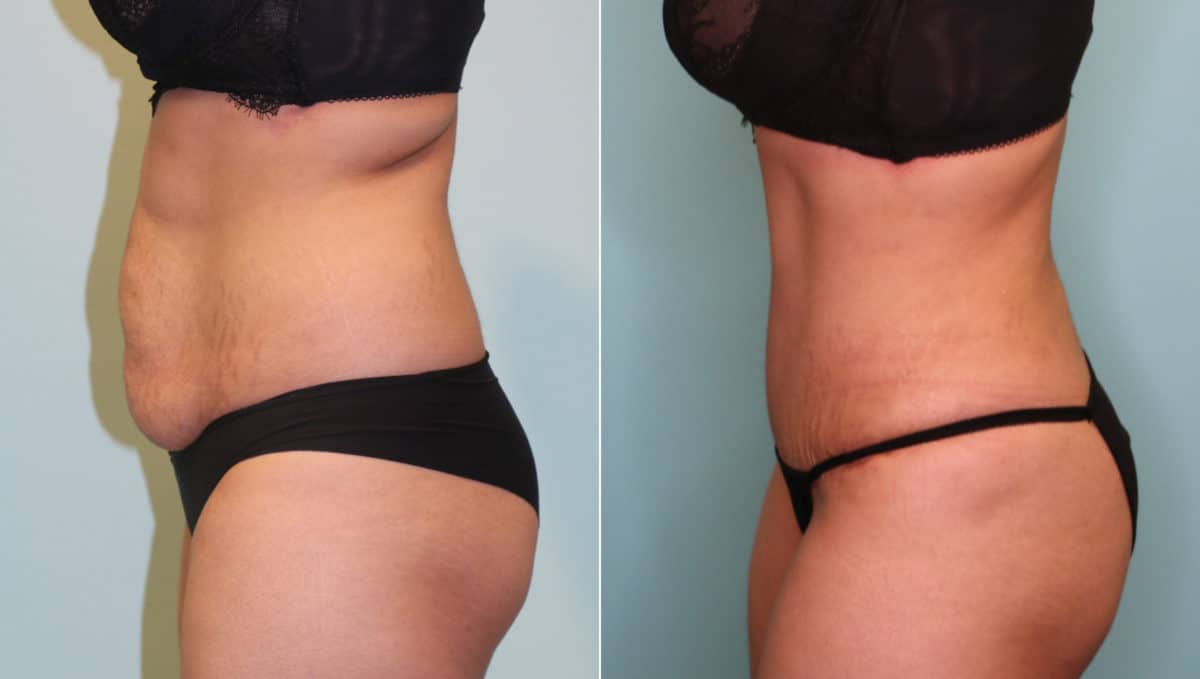 Patient 16059, Tummy Tuck Before and After Photos Before and after Tummy Tuck by Dr. Shervin Naderi, Patient 16059