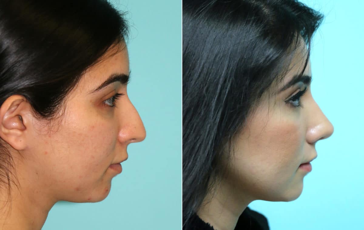 Before and after Rhinoplasty by Dr. Shervin Naderi, Patient 16295