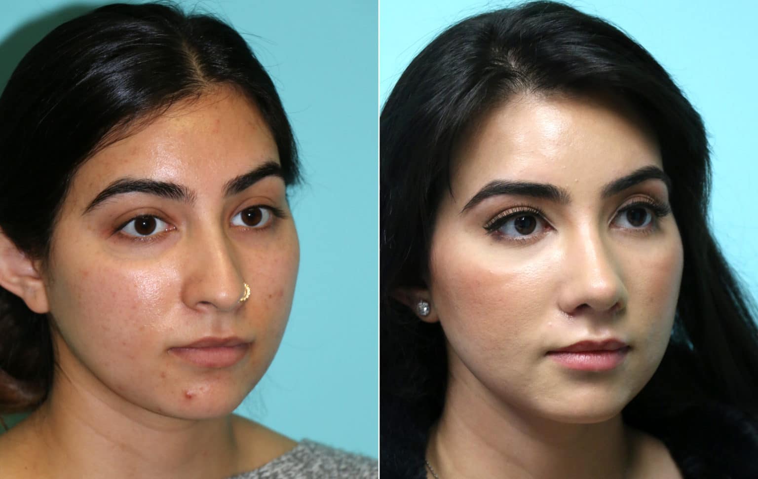 Rhinoplasty photos Chevy Chase, MD Patient 16295