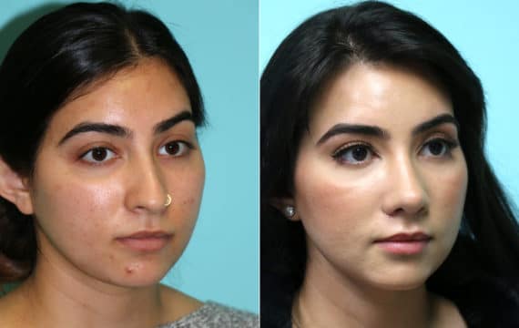 Before and after Rhinoplasty by Dr. Shervin Naderi, Patient 16295