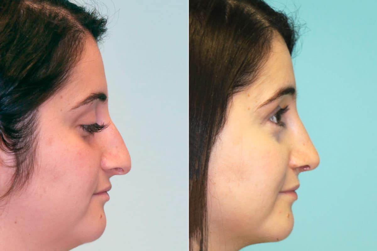 Before and after Rhinoplasty by Dr. Shervin Naderi, Patient 16427