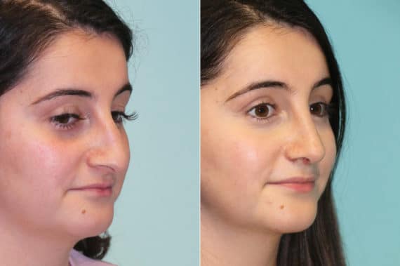 Before and after Rhinoplasty by Dr. Shervin Naderi, Patient 16427