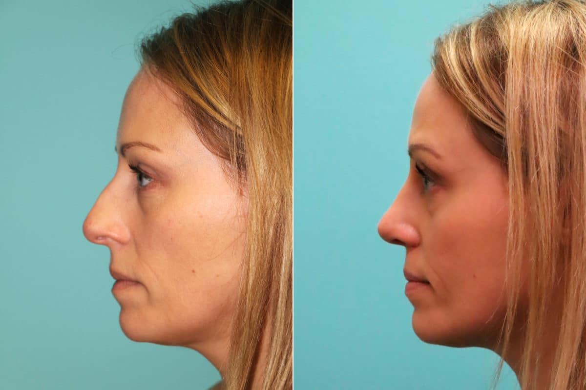 Before and after Rhinoplasty by Dr. Shervin Naderi, Patient 16395