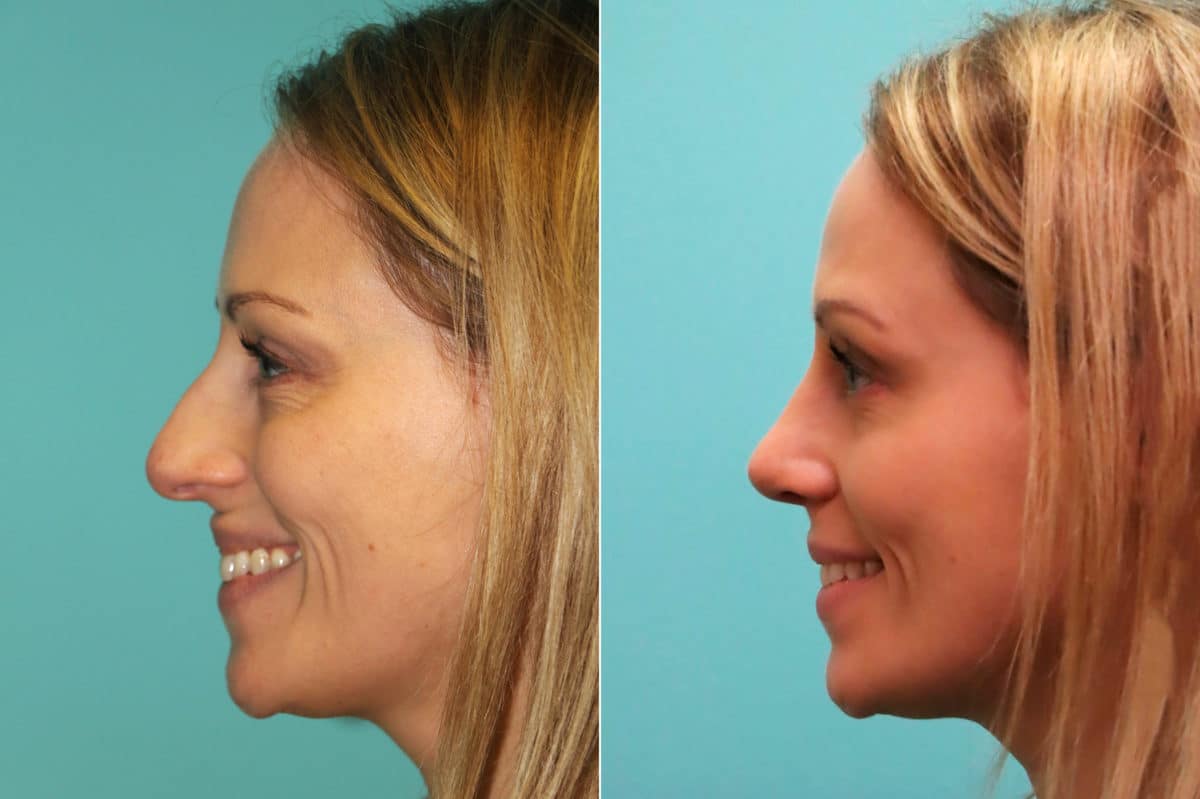 Before and after Rhinoplasty by Dr. Shervin Naderi, Patient 16395