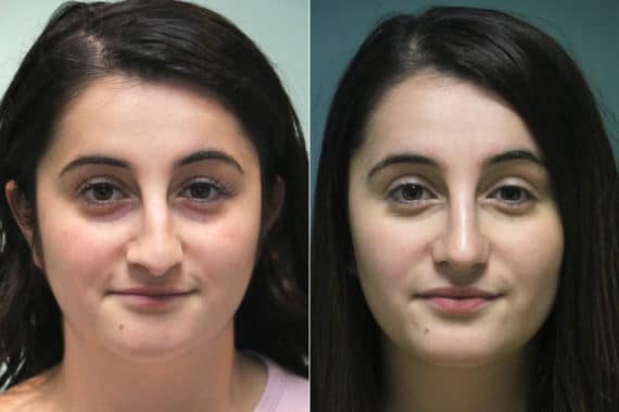 Before and after Rhinoplasty by Dr. Shervin Naderi, Patient 16427