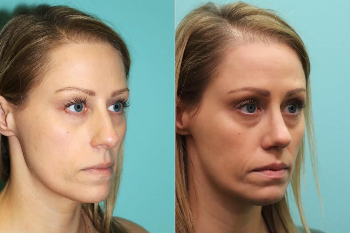 Before and after Rhinoplasty by Dr. Shervin Naderi, Patient 16395