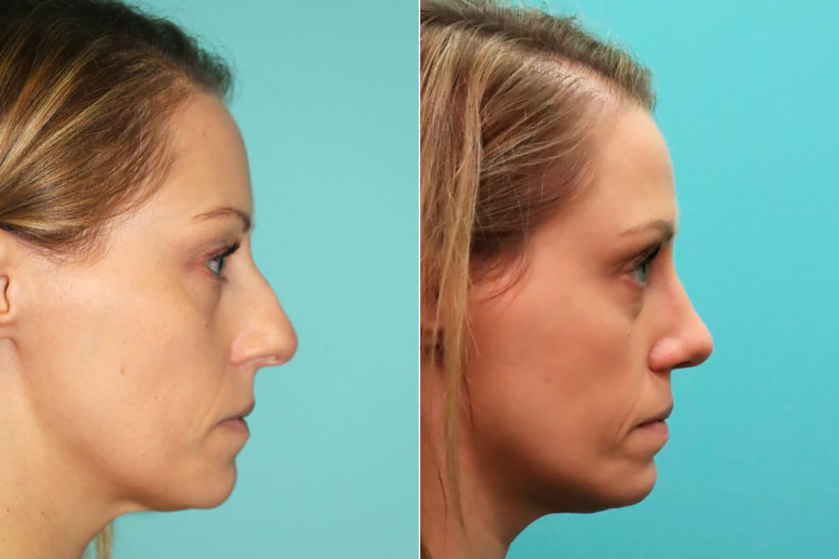 Before and after Rhinoplasty by Dr. Shervin Naderi, Patient 16395