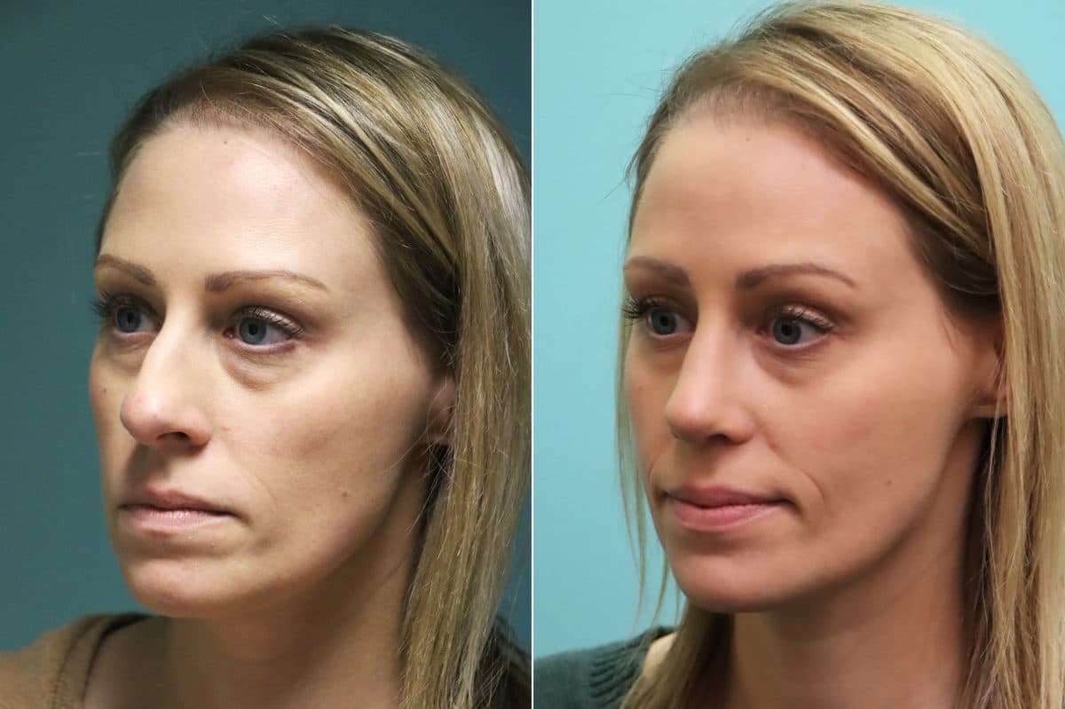 Before and after Rhinoplasty by Dr. Shervin Naderi, Patient 16395