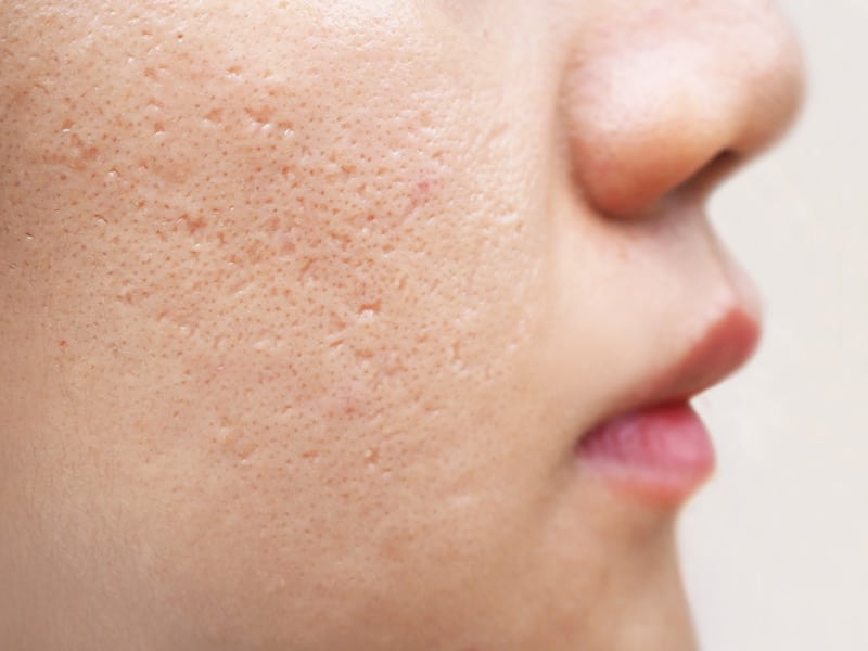 Ice pick scars are the most difficult kind of acne scar to treat. The Naderi Center | Virginia | Maryland  
