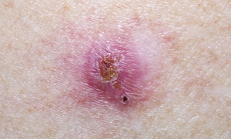 Basal cell carcinoma, The Naderi Center for Plastic Surgery and Dermatology | Virginia | Maryland  
