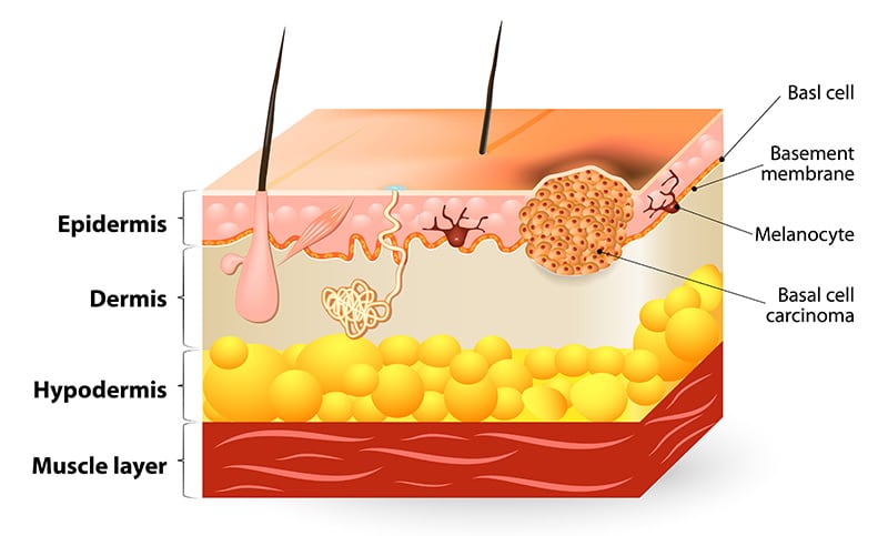 Basal cell carcinoma develops from the basement layer of the epidermis