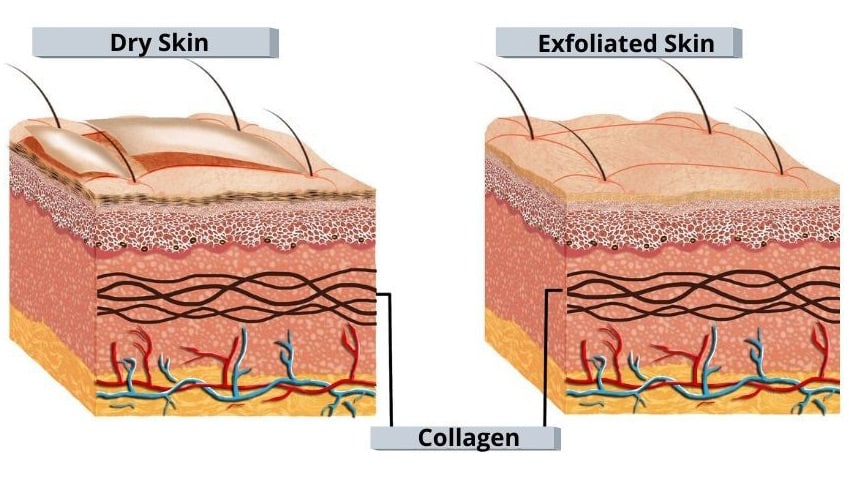 Dermaplaning will remove vellus hair by gently scraping across the skin with a surgical scalpel.