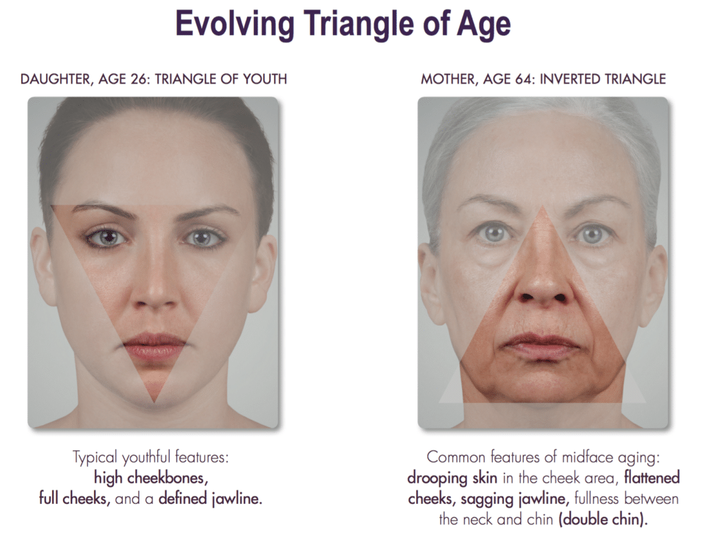 The triangle of age refers to mid-face aging which involves the sagging of the jawline, flattening of the cheeks and deepening of the nasolabial folds