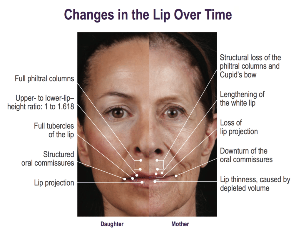 As we age many changes occur within the lips such as loss of lip projection, lengthening of the "white lip," loss of the cupid's bow, loss of lip volume and consequently formation of oral commisures or "lip lines."